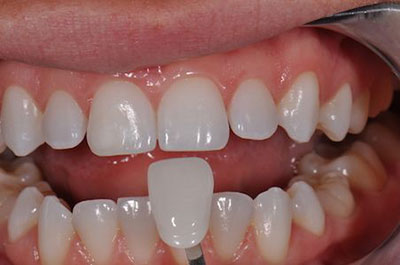 patient receiving dental veneers in Scottsdale, AZ