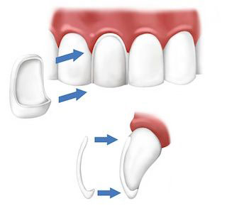diagram showing how dental veneers works